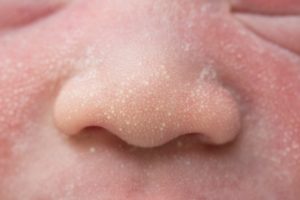 Ketahui Tentang Milia, Bintik Putih Kecil Pada Bayi