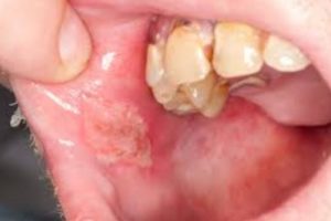 Penyebab dan Gejala Behcet Syndrome